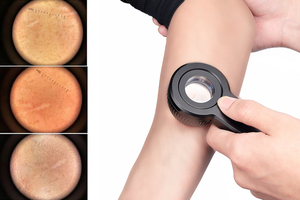 IBOOLO DE-3100 nuovo modo conveniente per l'esame di talpe lenti dermoscopiche con modalità doppia luce dermoscopio <span class=keywords><strong>prezzo</strong></span> - Product Image 2