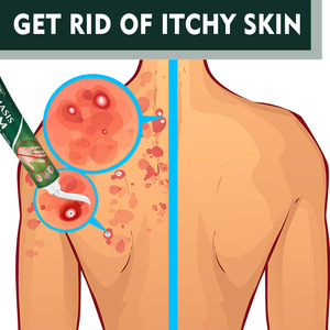 Crème réparatrice pour la peau South Moon, soulagement rapide des démangeaisons, psoriasis, crème réparatrice pour la peau, mousse, mains, pieds, pommade pour le traitement externe des champignons - Product Image 4