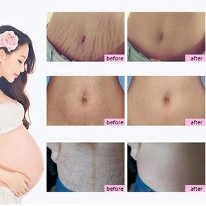 <span class=keywords><strong>Crema</strong></span> <span class=keywords><strong>per</strong></span> la riparazione della cicatrice della gravidanza con etichetta privata lozione biologica <span class=keywords><strong>per</strong></span> il trattamento del corpo smagliature - Product Image 6