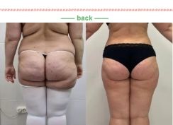 지방 흡입 지방 분해 바디 쉐이핑 슬리밍 장비 980nm1470nm 다이오드 레이저 제거 Papada f 리프트 - Product Image 4