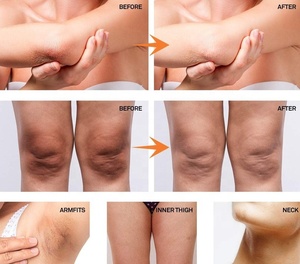 निजी लेबल अंतरंग त्वचा Whitening जेल चमकती शरीर ब्लीच क्रीम, योनि/गुदा के लिए विरंजन-सुरक्षित अंतरंग - Product Image 3