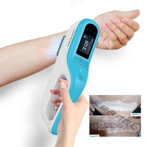 Láser Excimer Portátil Mini KN-5000E de 308nm en Oferta para el Tratamiento de Vitiligo, Psoriasis, Eccema y Pitiriasis <span class=keywords><strong>Rosea</strong></span> - Product Image 2