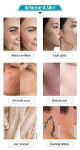 Appareil d'épilation au laser à diode à 4 longueurs d'onde, épilation au laser permanente, appareil de beauté, rajeunissement de la peau du visage et du corps - Product Image 6