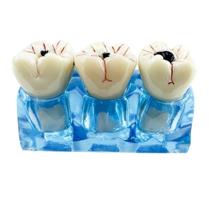 Modèle dentaire pathologique amovible 4 en 1 : Anatomie des caries, décomposition des dents, éducation et hygiène buccale polyvalente - Product Image 3