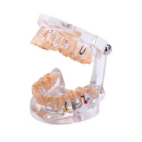32 dientes mes completo implante enfermedad dientes modelo claro diseño implatn dientes estudio modelo dentsit uso patología dental modelo