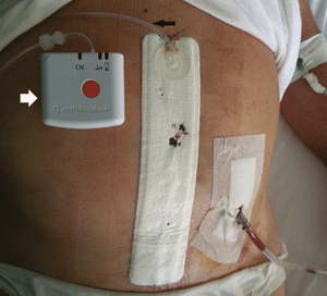 YAFHO RECO NPWT <span class=keywords><strong>kit</strong></span> de pansement en Silicone consommables médicaux - Product Image 4