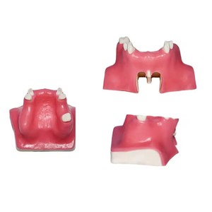 Modèle de communication médecin-patient pour l'implantation dentaire, aide pédagogique orale de classe I pour le lifting du sinus maxillaire, dents manquantes - Product Image 2