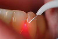 Équipement laser à diode dentaire à bas prix 980nm 30w, machine laser de dettistrie pour clinique