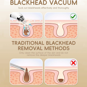 Pakiss เครื่องกำจัดสิวหัวดำไฟฟ้าเครื่องทำความสะอาดรูขุมขนบนใบหน้าแบบชาร์จไฟได้พร้อมวัสดุพลาสติก ABS - Product Image 5