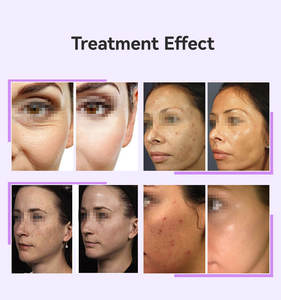 Dispositivo Eléctrico Profesional de Alta Frecuencia para Salón de Belleza, Varita de Electrodo de Vidrio, Varita de Terapia para la Piel para el Acné, Arrugas y Cuidado del Cabello 9 - Product Image 4