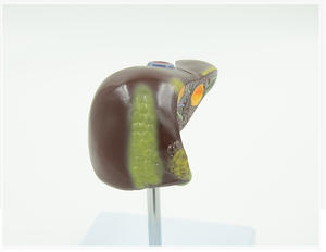 PVC病的肝臓モデルが一般的な肝および胆嚢障害を視覚化 - Product Image 6
