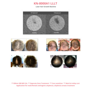 Perangkat LLLT Terlaris KN-8000A1 - Timer Otomatis 25 Menit, Terapi Cahaya Merah 650nm untuk Kesehatan Kulit Kepala dan Rambut - Product Image 4