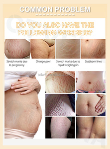 OTVENA Crème Raffermissante Haute Qualité pour le Corps, Élimine les Cicatrices de Grossesse, Traitement de l'Acné, Vergetures, Réparation et Brûle-Graisse - Product Image 3