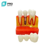 Modèle de développement de caries dentaires, modèle de dents dentaires pour l'étude de l'anatomie des dents dentaires, éducation médecin-patient et soins bucco-dentaires