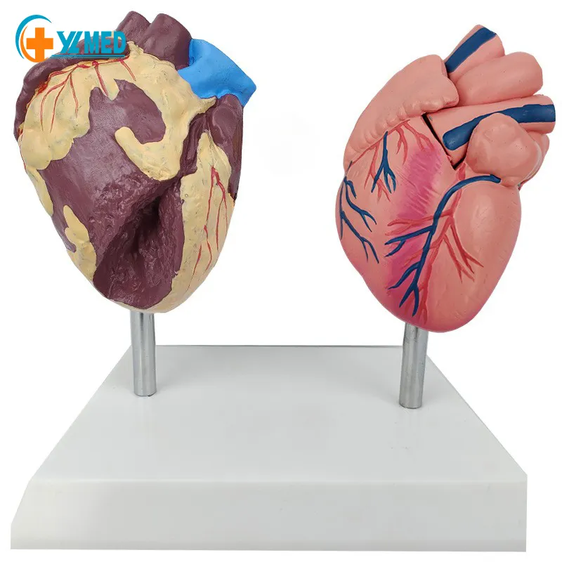 Menselijk Anatomie Hartmodel 2 Delen Pvc-Leermodellen Hart Gezondheid En Ziek Vergelijken Hartmodel