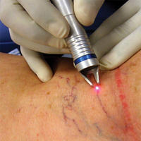 Laser Diode Portable Dimed Berylas 980nm 15W Refroidi par Air Certifié CE Garantie 2 Ans pour les Varicosités, les Veines d'Araignée et les Télangiectasies
