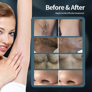 KES công nghệ mới Soprano Titan Máy tẩy lông bằng laser không đau Máy làm đẹp cho giá xuất xưởng - Product Image 6