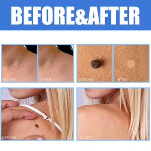 Crema OEM para el tratamiento de las verrugas, cuello, etiqueta para la piel, axila, verrugas planas, genitales, PIES, callos, crema, pomada para eliminar verrugas - Product Image 5