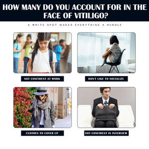 Chaude En Gros Bonne Qualité South Moon Vitiligo Spray Hydratant <span class=keywords><strong>Taches</strong></span> <span class=keywords><strong>Blanches</strong></span> Leucoplasie <span class=keywords><strong>Maladie</strong></span> Pigment Mélanine White Tag Care - Product Image 3