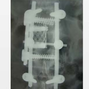 Orthopedische <span class=keywords><strong>Implant</strong></span> Titanium Mesh Met Anterior Platen Cilindrische Interbody Fusion Kooi Prismatische Gat - Product Image 3