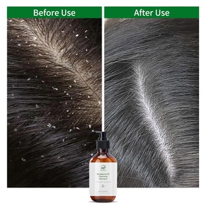 Champú Profesional <span class=keywords><strong>para</strong></span> <span class=keywords><strong>el</strong></span> Cuidado del Cuero Cabelludo, Anticaspa, Antibacteriano, Anti-picazón, Inhibe <span class=keywords><strong>el</strong></span> <span class=keywords><strong>Hongo</strong></span> Malassezia, Champú <span class=keywords><strong>para</strong></span> <span class=keywords><strong>el</strong></span> Cabello con Ácido Salicílico - Product Image 3