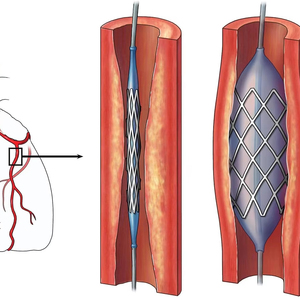Il produttore ha personalizzato l'acciaio inossidabile durevole di alto livello medico sblocca uno <span class=keywords><strong>Stent</strong></span> vascolare dei vasi sanguigni ostruito - Product Image 1
