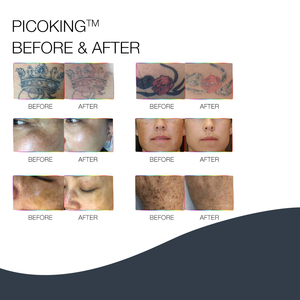 350 पीएस पियोलजर टैटू हटाने मशीन स्ट्रेच निशान हटाने 3500 त्वचा के उपचार के लिए 1 याग सौंदर्य उपकरण - Product Image 3