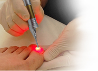 Laser à Diode Offre Spéciale 980nm pour le traitement des champignons des ongles Thérapie portable Onychomycose Dispositif de podologie le plus efficace