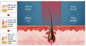 Equipo de Crecimiento Capilar para la <span class=keywords><strong>Alopecia</strong></span> Androgenética y la <span class=keywords><strong>Alopecia</strong></span> <span class=keywords><strong>Areata</strong></span>, Diodo Láser con Carro para Fácil Movilidad en Interiores - Product Image 5