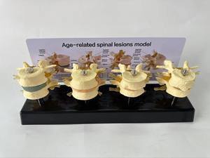 Vertebra lombare malata modello di ernia disco osteoporosi insegnamento ortopedico umano modello di comunicazione medico-paziente - Product Image 4