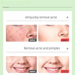 40 Parches Neutros Brillantes para Granos, Parches Hidrocoloides Faciales, Lindos Parches con Purpurina para Granos, Ideales para Conciertos y Fiestas - Product Image 4