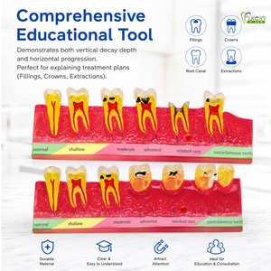 Modèle éducatif sur la progression des caries dentaires, directement de l'usine, pour les cliniques dentaires, les écoles et la formation des patients. Marque privée. - Product Image 6