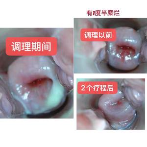 Poudre désinfectante antibactérienne à base de plantes naturelles Sailing pour la réparation de l'érosion cervicale, la réduction de la chaleur et le traitement de l'antivaginite (Yoni Pops) - Product Image 5