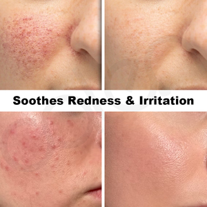 Sérum facial à l'acide azélaïque Oalen Private Label, hydratant, soin des imperfections, réduit les rougeurs de la <span class=keywords><strong>peau</strong></span>, adapté aux peaux sensibles et grasses - Product Image 3