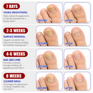 Meilleure Vente : <span class=keywords><strong>Traitement</strong></span> <span class=keywords><strong>des</strong></span> <span class=keywords><strong>Ongles</strong></span> Antifongique à l'Hydrogel (21 Patchs) – Soin Réparateur <span class=keywords><strong>des</strong></span> <span class=keywords><strong>Ongles</strong></span> <span class=keywords><strong>des</strong></span> Pieds, Renouvellement Nocturne, Patchs Antifongiques <span class=keywords><strong>pour</strong></span> <span class=keywords><strong>Ongles</strong></span> Abîmés - Product Image 4