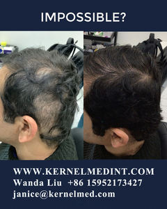 Natural Cabelo-Perda Prevenção Óleo De Crescimento De Cabelo Minoxidil Tricoscopia Máquina Lllt Laser Terapia Cabelo Tratamento Máquina KN-8000A - Product Image 5