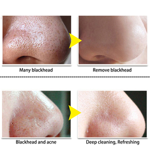 <span class=keywords><strong>LANBENA</strong></span> หน้ากากป้องกัน<span class=keywords><strong>สิว</strong></span>หัวดำแบบลอกออกได้,แผ่นปิดรูขุมขนจมูกสติกเกอร์แผ่นปิดใบหน้ารักษาสิว - Product Image 3