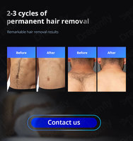 Mesin Laser penghilang rambut, teknologi canggih, pulsa panjang terbaik 755 & 1064nm Laser REAL Alexandrite Alex harga alat tulis