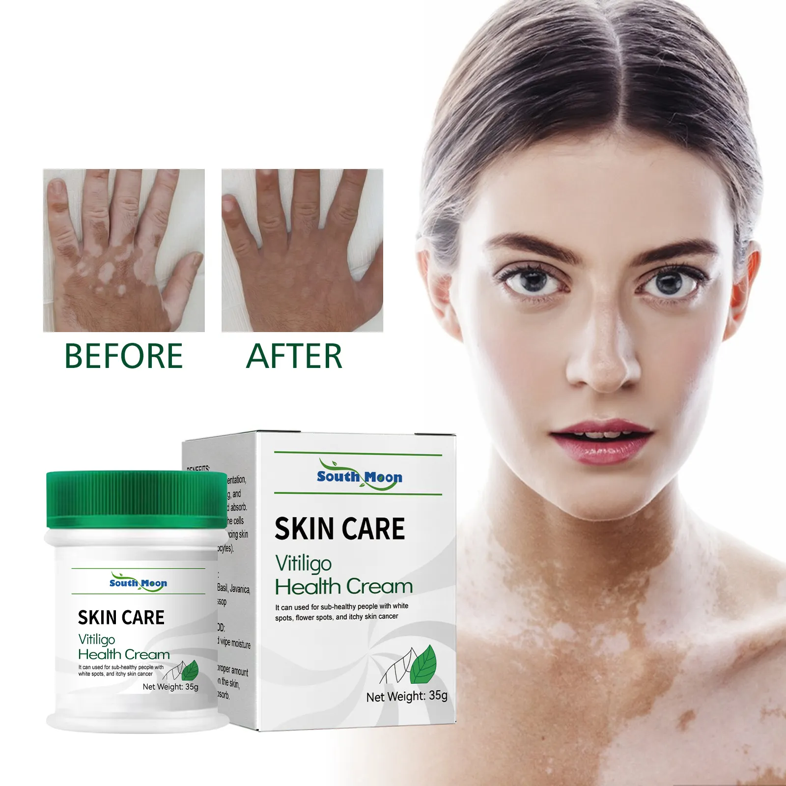 New Spot Melanin Reparatur Akne Spot Entfernung White Spot Behandlung Creme Beauty Ultra Skin Barrier Aufhellung Haut Vitiligo Creme