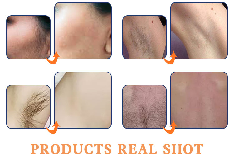 New Diode Laser Multifunction Laser Hair Removal Machine China