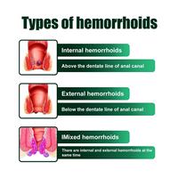 Crème Bactériostatique HYH et Pommade Anti-Hémorroïdes Chinoise pour Corps Jambes Traitement Efficace Certifié CE