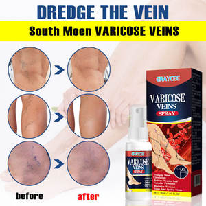 <strong>Best</strong> Sellers Herbal Varicose Vein Spray Treat Vasculitis Phlebitis Pain Relief <strong>Cream</strong> Spots OEM ODM - Product Image 5
