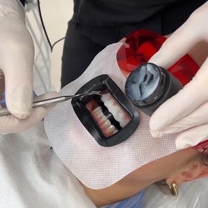 Resistente alle alte temperature fino a 121°C ℃   Divaricatore per Guance e Labbra in Materiale TPE per Uso Dentale, Apertura Bocca, <span class=keywords><strong>Oltre</strong></span> lo Sbiancamento dei Denti - Product Image 5