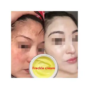 Crema viso di alta qualità rimozione sbiancante melanina Melasma rinfresca crema sbiancante per la rimozione delle lentiggini