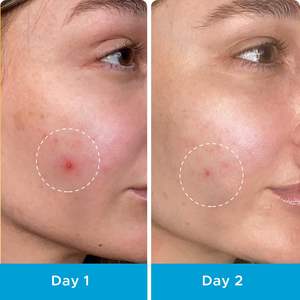 Patch hydrocolloïde OEM absorbant l'huile d'arbre à thé 12 <span class=keywords><strong>points</strong></span> pour le traitement des taches d'acné couvrant les imperfections de l'aloe vera. - Product Image 5