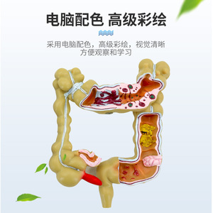 Modelos patológicos de intestino grueso, modelo de colon pequeño, modelo de lesiones del intestino grueso, enfermedades intestinales, modelo de lesiones del colon - Product Image 3