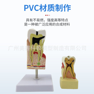 Molares ampliados 3 veces, patología dental completa, dientes transparentes, caries dentales, enseñanza de comunicación con pacientes dentales - Product Image 1
