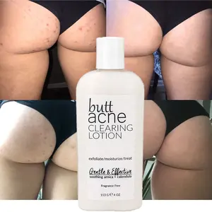 Oem Private Label Speciale Bil Verlichten Jeuk Acne Behandeling Crème Butt Acne Clearing Lotion Voor Body, Rug, Bum, & Dij