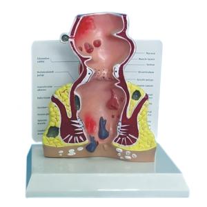 Modello Anatomico di Emorroidi Anorettali Umane con Malattie Rettali Comuni per l'Insegnamento in Gastroenterologia - Product Image 2