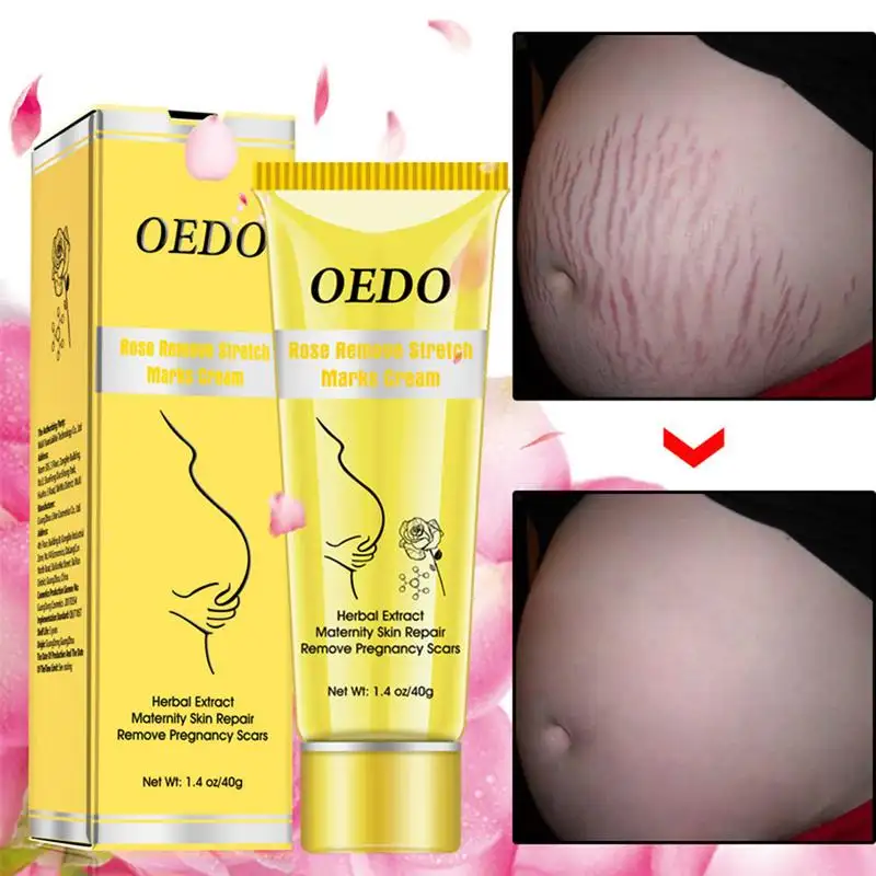 1,4 Oz/40G OEDO Роза, Удаление Следов растяжек крем против морщин, против старения, беременности и родам восстановления кожи удаления беременности шрамы тела